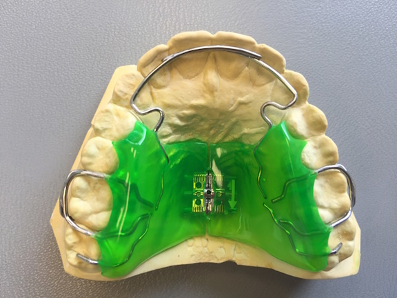 mykie®, Maximilian Schreiner, Kieferorthopädie California Smile Grafing