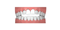 offener biss kieferorthopäde grafing california smile maximilian schreiner