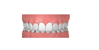 ueberbiss kieferorthopäde grafing california smile maximilian schreiner