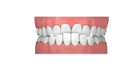 unterbiss kieferorthopäde grafing california smile maximilian schreiner