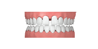 zahnlücken kieferorthopäde grafing california smile maximilian schreiner