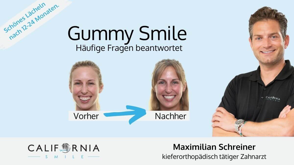 gummy smile grafing kieferorthopäde california smile maximilan schreiner